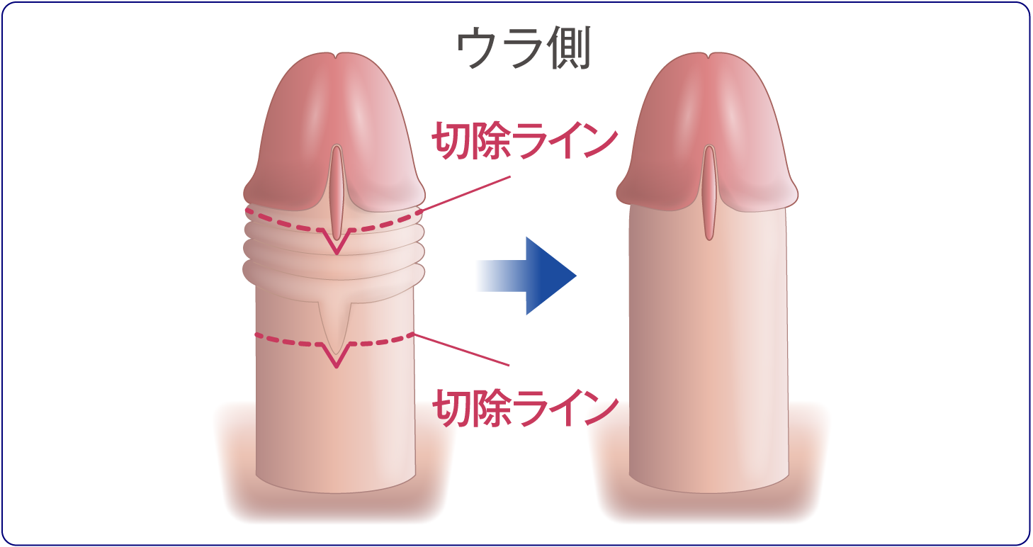 傷跡が目立ちにくい自然な仕上がり（ウラ側）