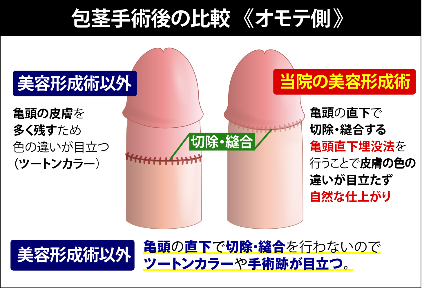 包茎手術後の比較（オモテ側）