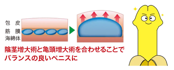 陰茎増大術注入法