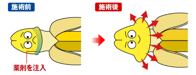 カリ高注入法